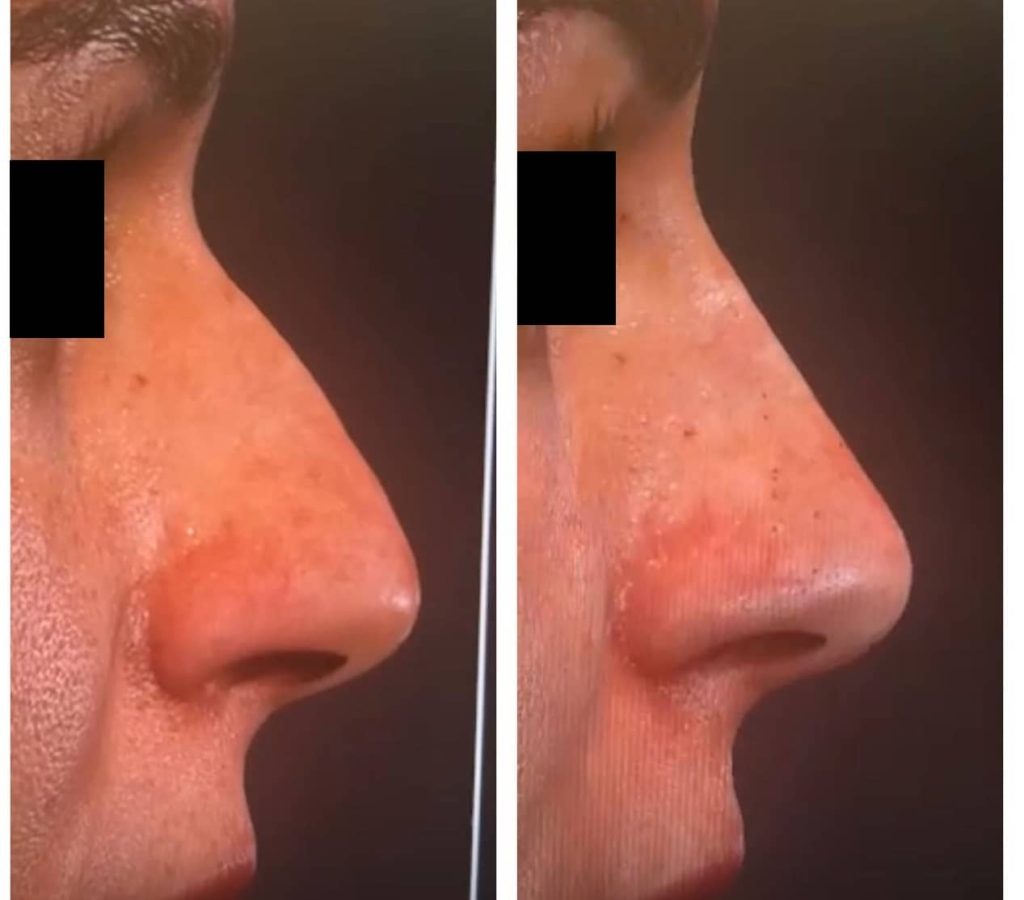 Rinomodelação com ácido hialurônico (sem cirurgia)