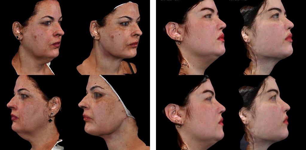 002 - Lipo de Papada