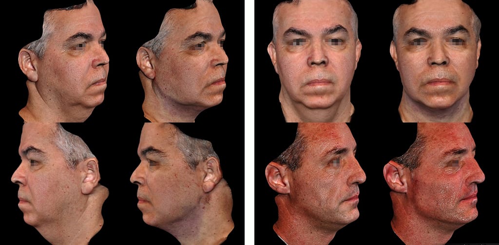 003 - Lipo de papada homem e definição mandibula