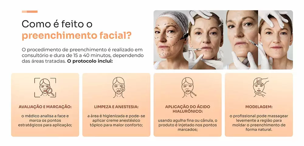 Passo a passo do preenchimento facial: avaliação, limpeza, aplicação de ácido hialurônico e modelagem do resultado