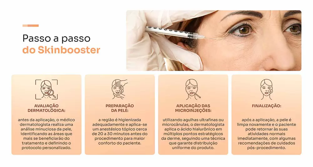 Infográfico mostrando as 4 etapas do skinbooster - avaliação dermatológica, preparação da pele, aplicação de microinjeções de ácido hialurônico e cuidados finais