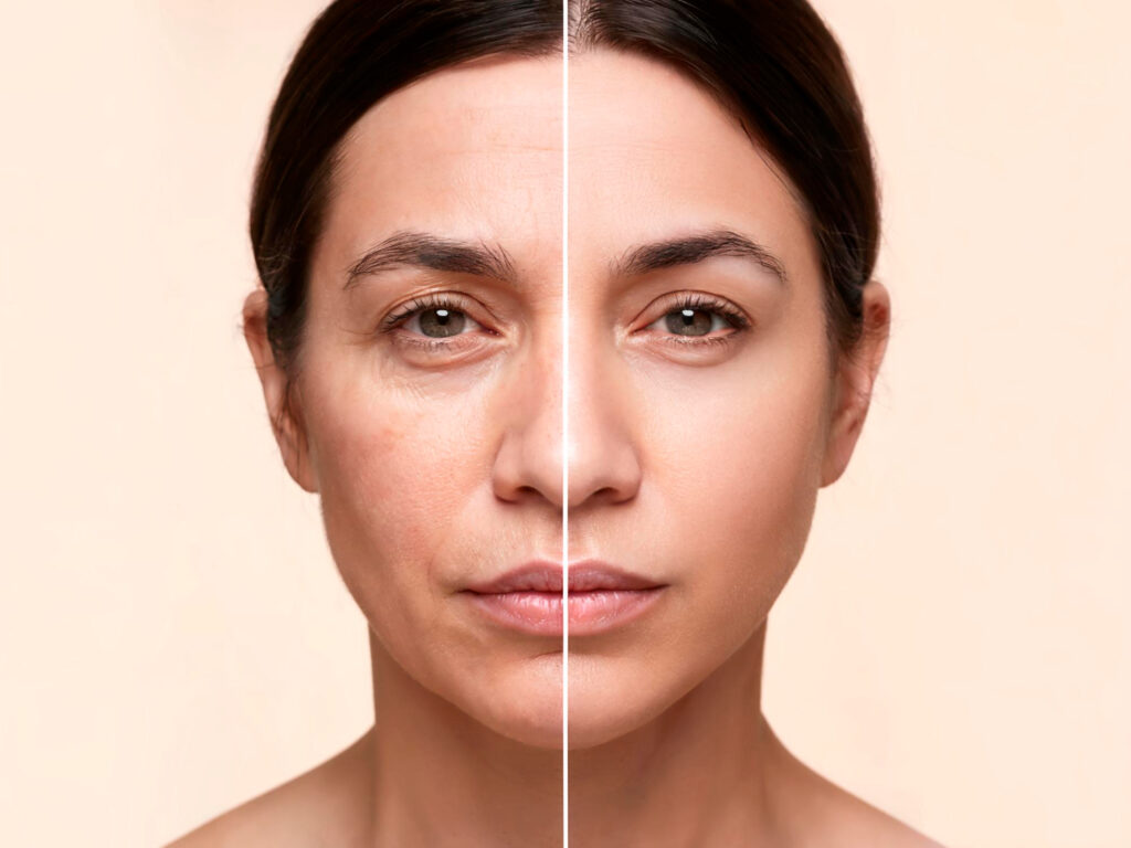 Comparação antes e depois mostrando os resultados do skinbooster: redução de linhas finas, melhora da textura e luminosidade da pele com hidratação profunda e rejuvenescimento visível.