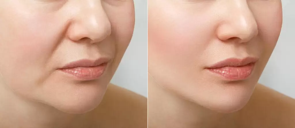 Antes e depois de preenchimento labial com ácido hialurônico mostrando resultado natural e harmonioso nos lábios