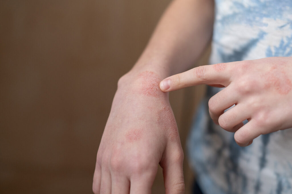 Mão com placas avermelhadas e descamativas sendo apontadas pelo dedo, representando irritação cutânea típica de dermatite.