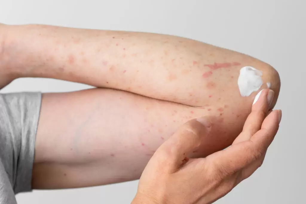 Cotovelo com manchas avermelhadas e aplicação de pomada para psoríase.