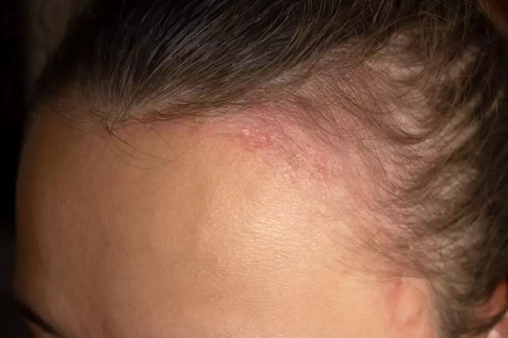 Lesão de psoríase no couro cabeludo com vermelhidão e descamação.