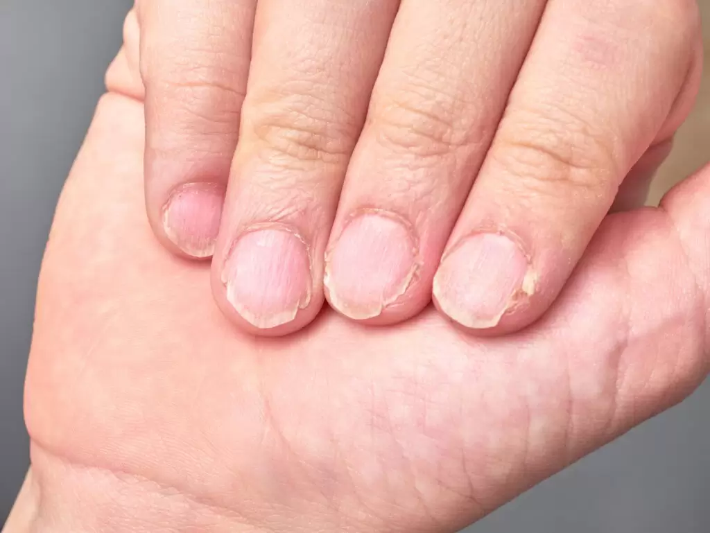 Unhas com descamação, irregularidades e alteração na superfície associadas à psoríase ungueal.