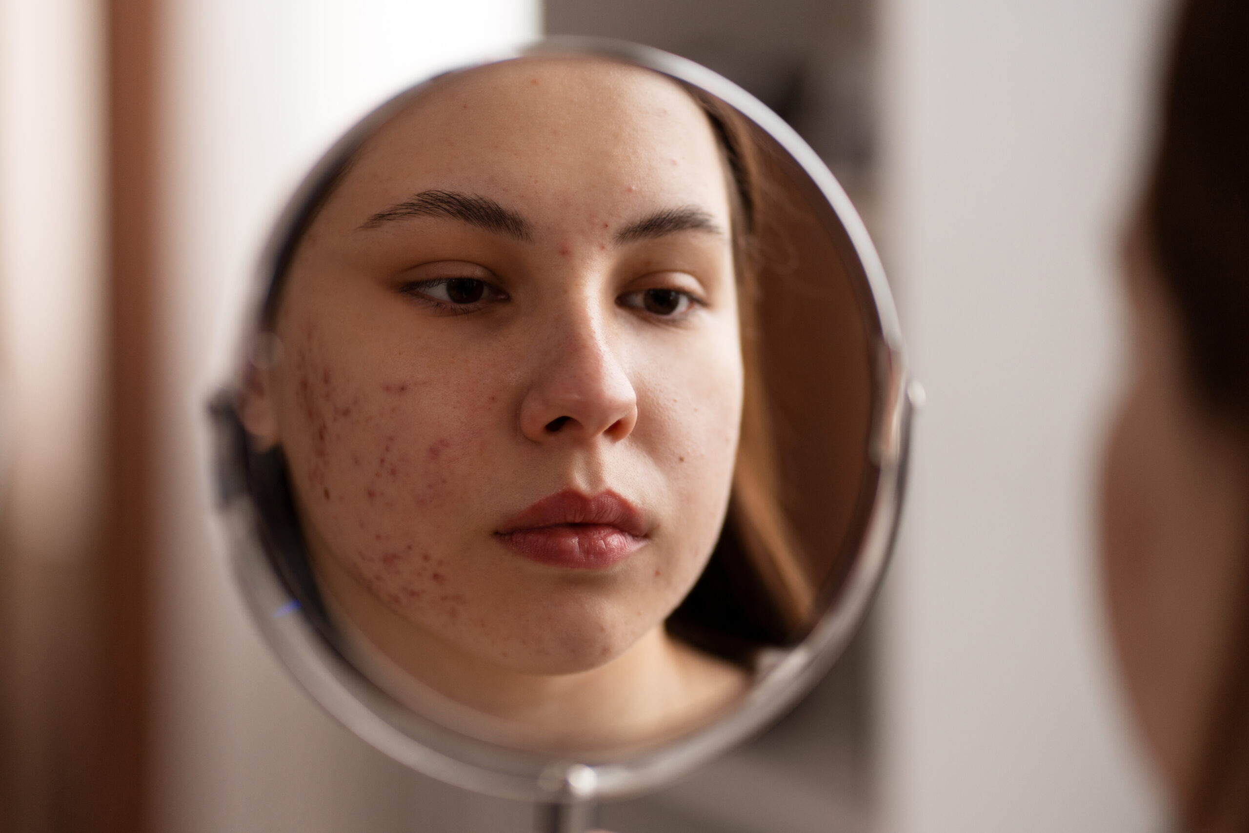 Mulher observando acne no espelho buscando tratamento dermatológico - Dr. Paulo Junqueira.